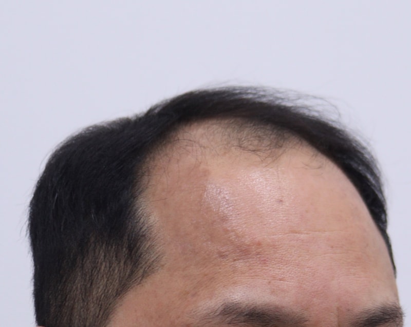 1. 수술전_3.JPG