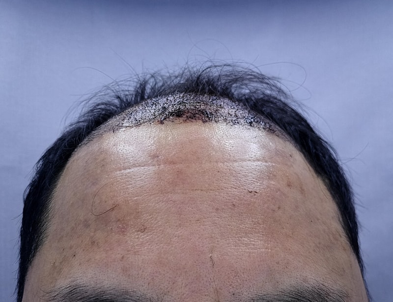 2. 수술후_1일_1.jpg