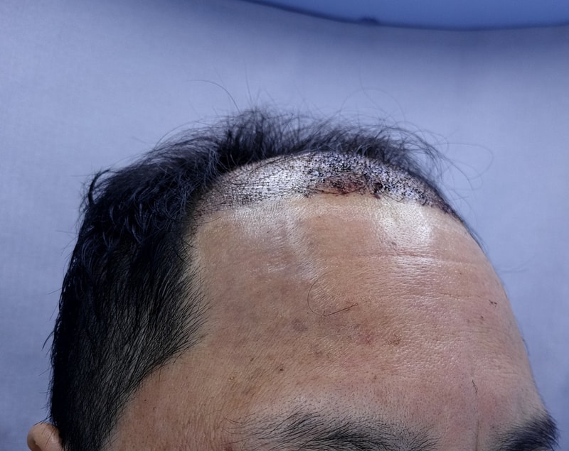 2. 수술후_1일_3.jpg