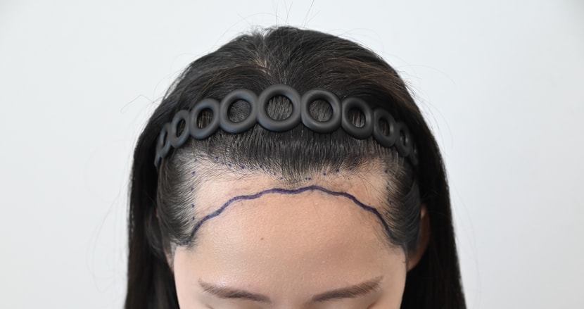 수술 전 디자인