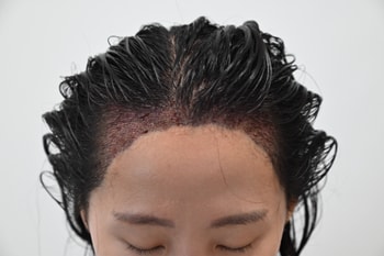 수술 다음날 샴푸 후