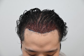 시술 후 첫 샴푸