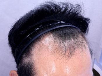 수술전