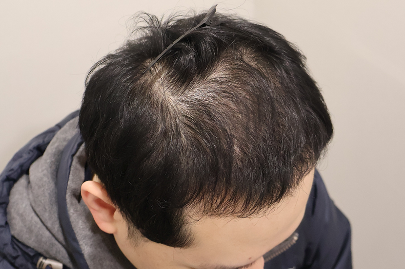 수술후