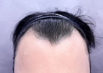 수술전