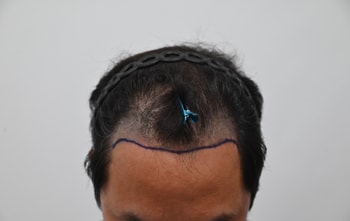 수술전