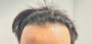수술 전