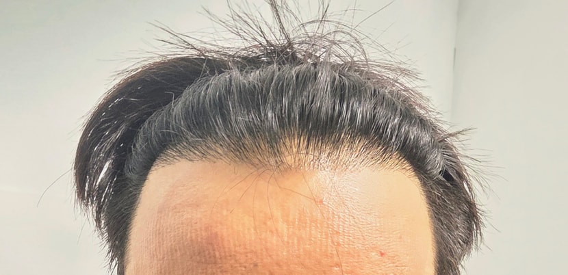 수술 전