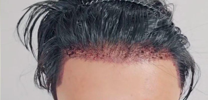 수술 후