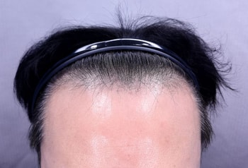 수술전