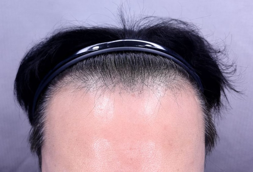 수술전