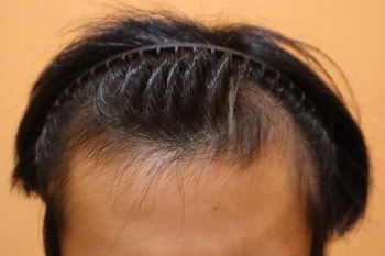 모발이식 받기전