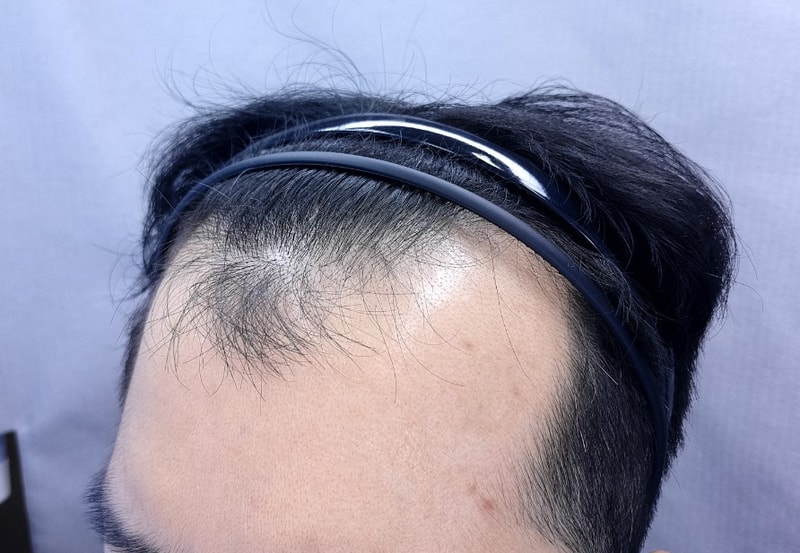 이현형 수술전 헤어라인3000.jpg