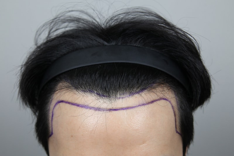 모나라모발이식 (3).jpg