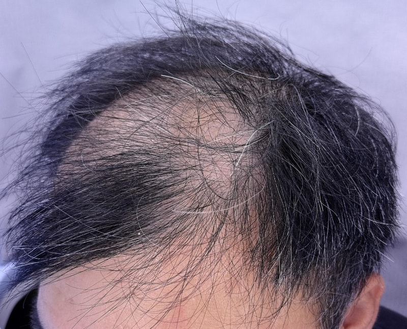김두엽 3500 수술전.jpg