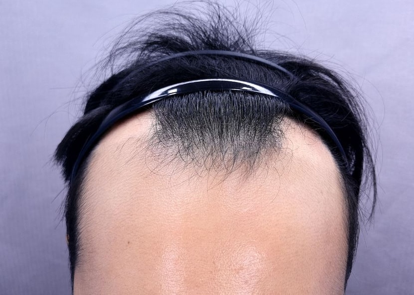 수술전