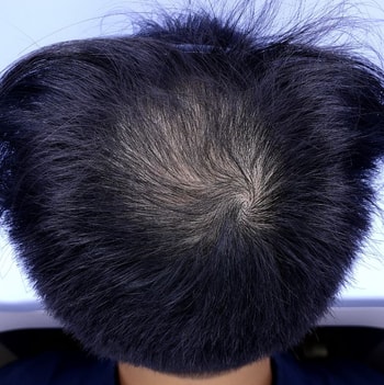 정수리9개월전