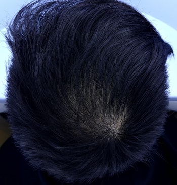 정수리9개월후