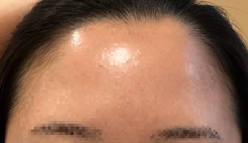 수술전