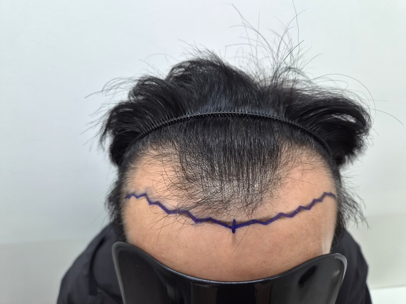 수술전
