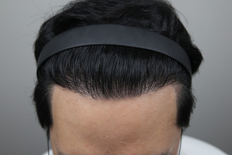 모나라모발이식_4400모경과-(4).jpg