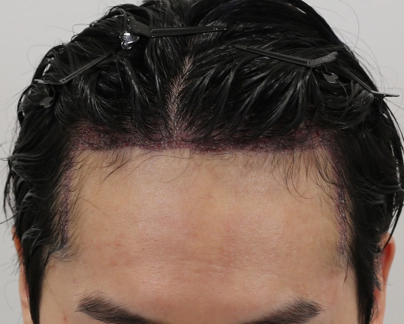 오형석 수술후.JPG