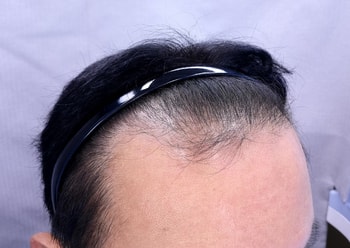수술전