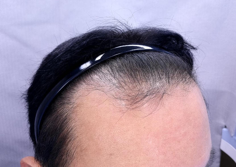 수술전