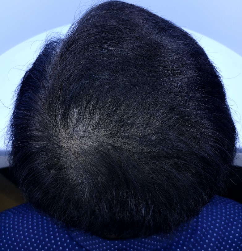 이용운 정수리 smp,mts6.jpg