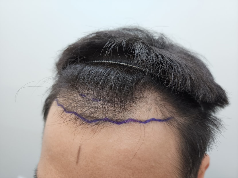 수술 전 