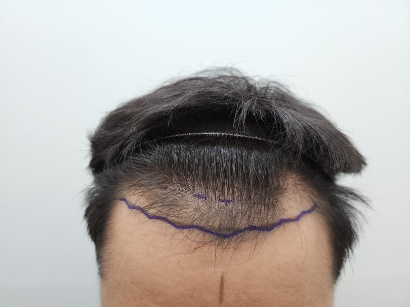수술전