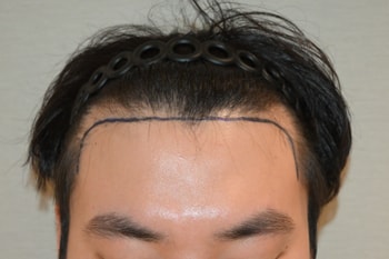 수술 전