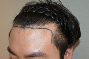 수술 전
