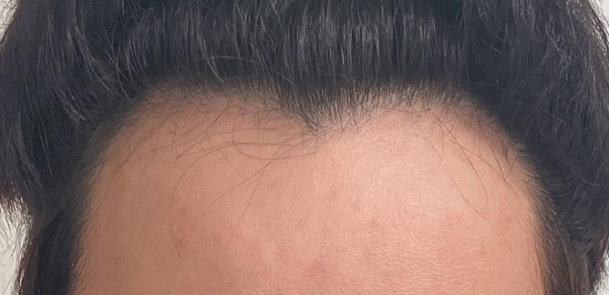 수술 전