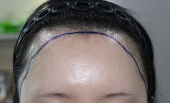 수술 전