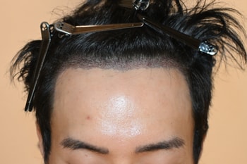 수술 다음날