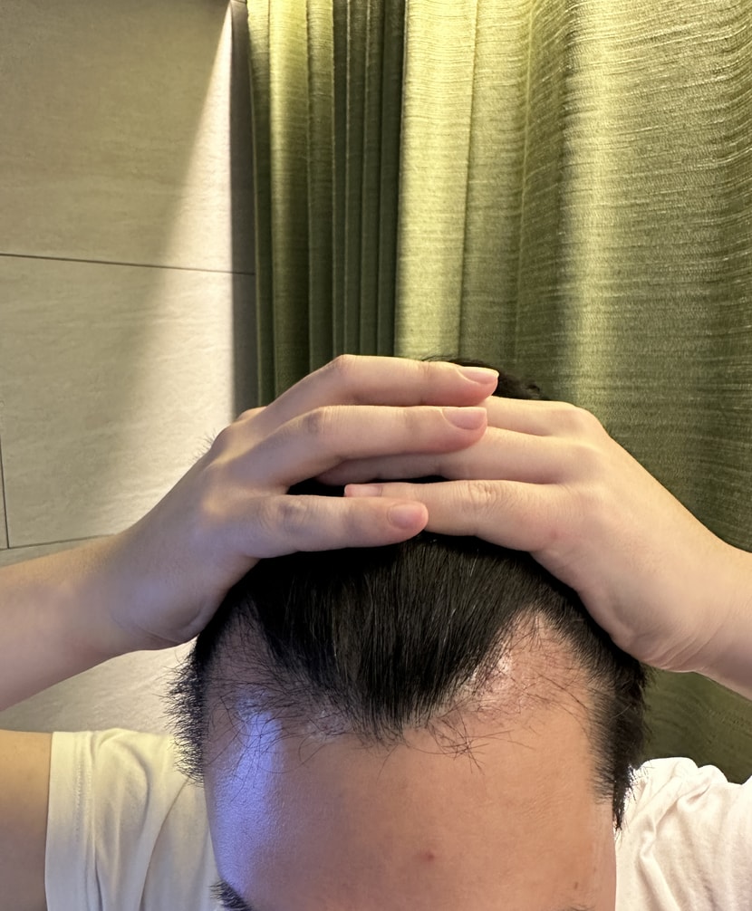 수술3개월암흑기 ㅎㅎ