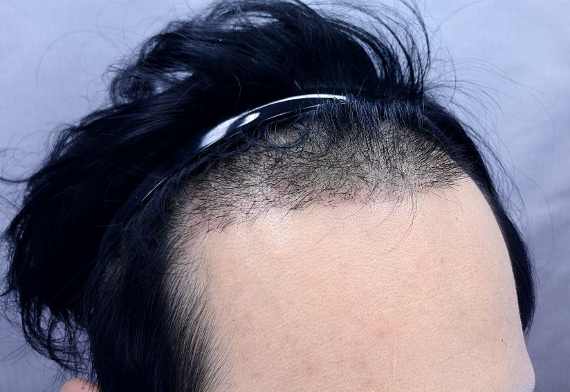 수술후