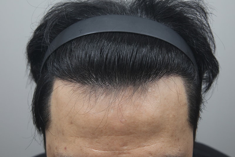 모나라피부과_모발이식_12개월경과-(1).jpg