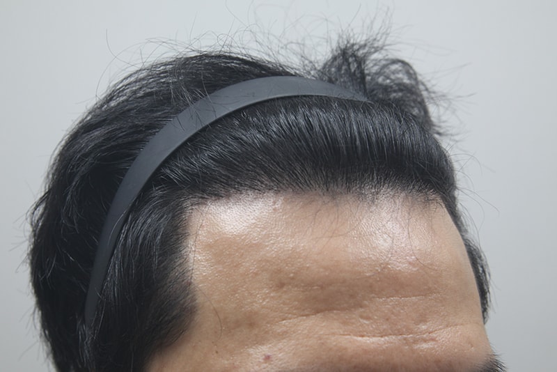 모나라피부과_모발이식_12개월경과-(3).jpg