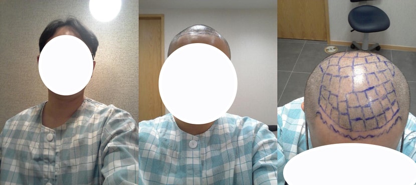 수술전