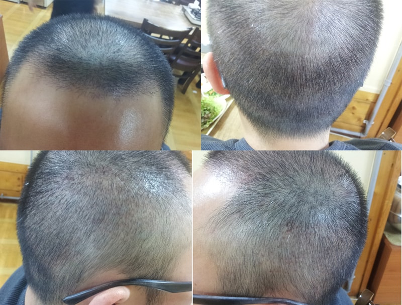 수술 보름후.jpg