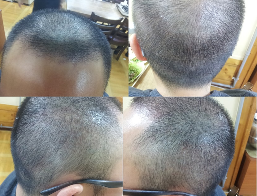 수술 보름후