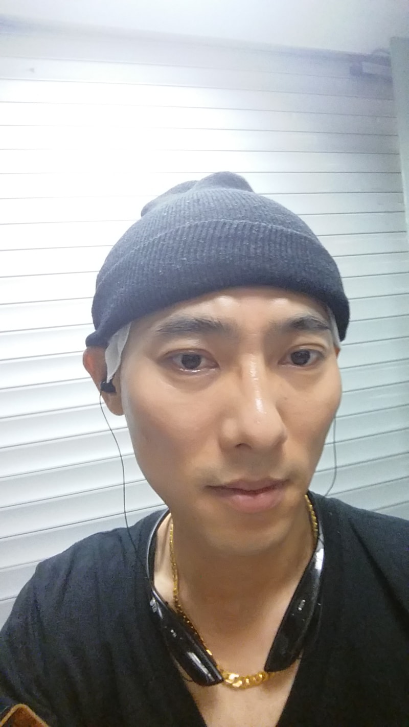 드디어 오늘 대전 모담에서 2000모낭 80모낭 써비스 이식했습니다