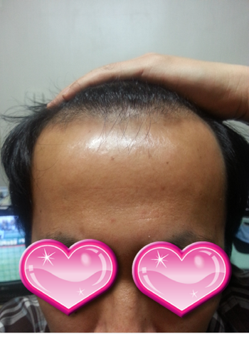 모발이식 전 정면 사진입니다.