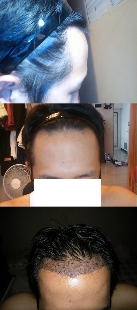 ★22~25 인도 2500모낭 이식수술후기입니다.★