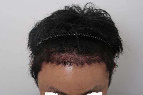 수술다음날 (3).JPG