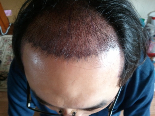 수술후 사진 3일재 1