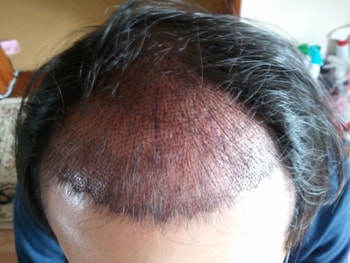 수술후 사진 3일재 1