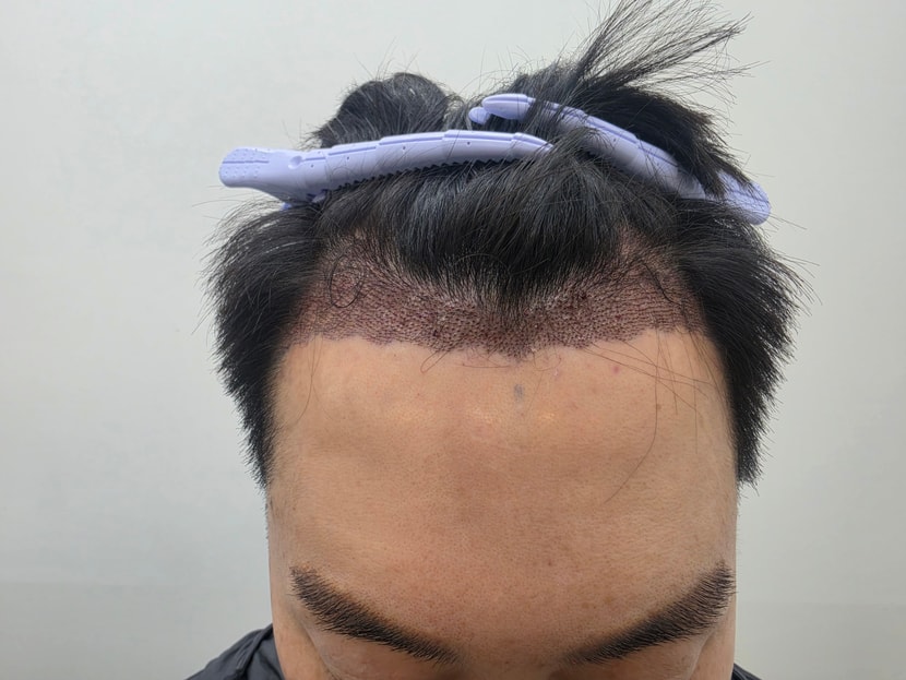 시술다음날